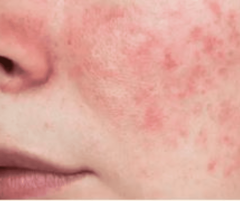 Irritated Sensitive Skins